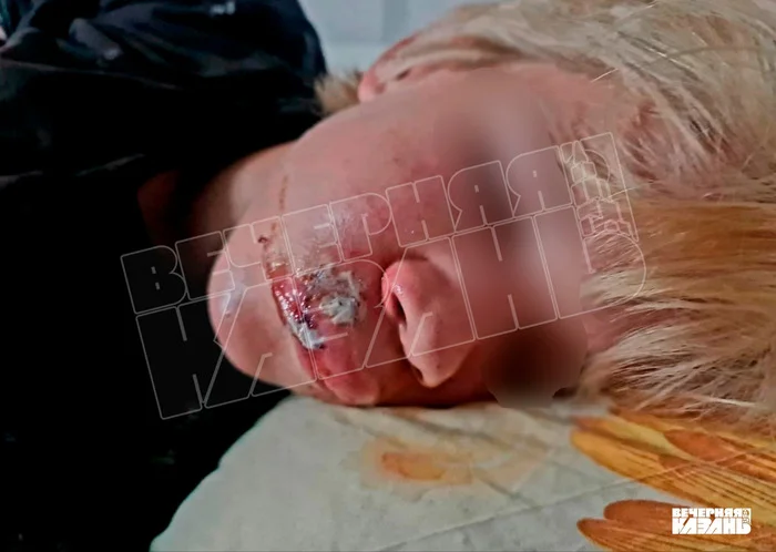 Нападение в Усадах: подростки на питбайках избили мальчика из-за дружбы с девочкой