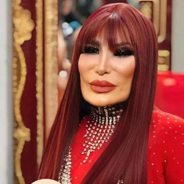 Пугачева, Михайлов и другие: странная мода на «надутые» лица