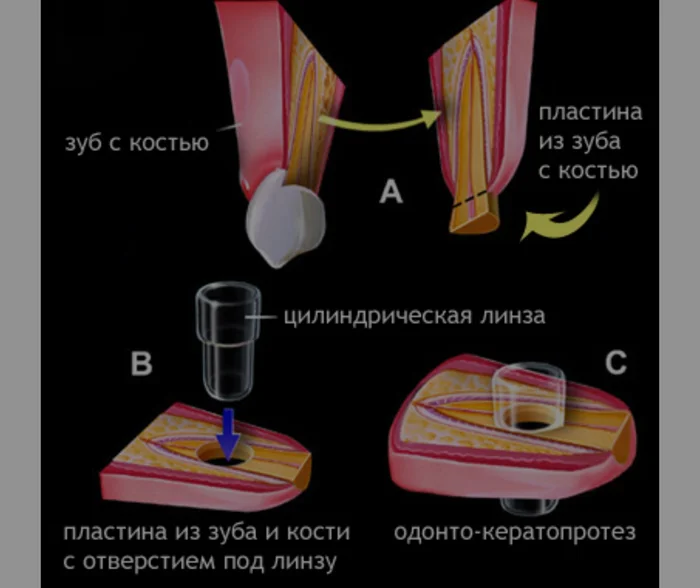 Зуб в глазу: зачем врачи пересаживают зуб для восстановления зрения?