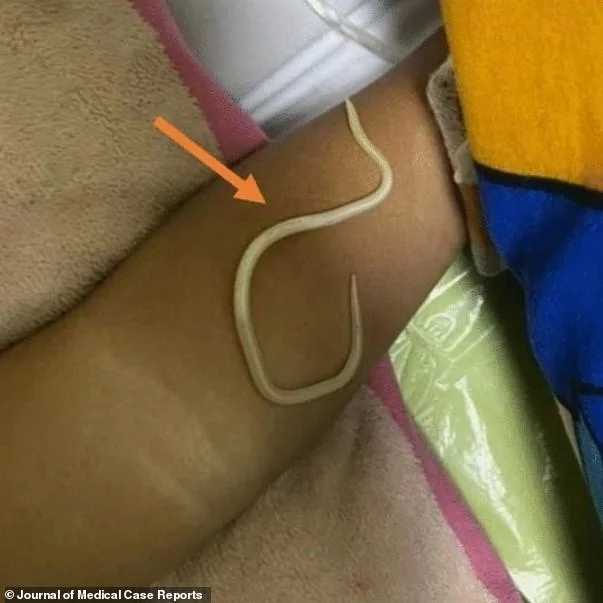 Почему не стоит пить сырую воду: кадры удаления огромных паразитов из тела