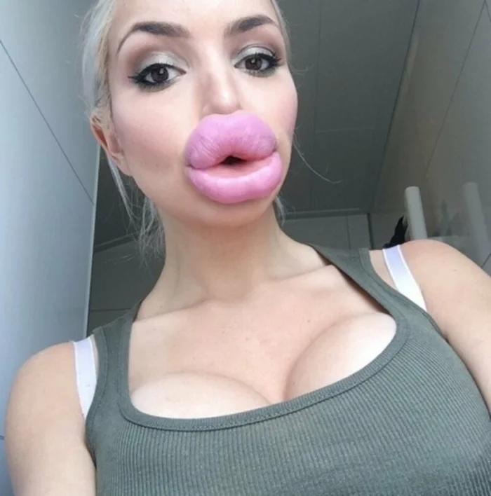 Губы, как батуты: мужские мысли о моде на накачку