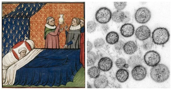 Потница — смертельная болезнь, уносившая жизни европейской знати