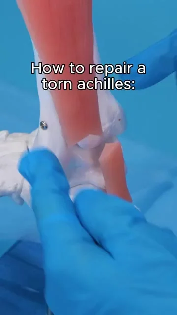 Порван ахиллес: современные методы лечения