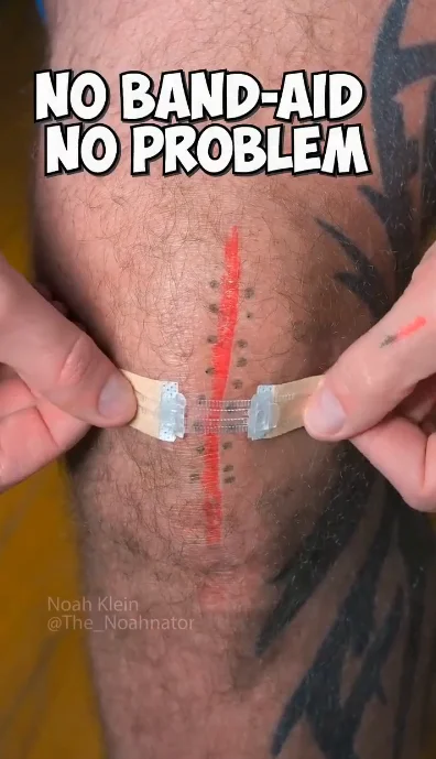 Как стянуть рваную рану