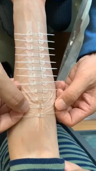 Как закрыть рваную рану⁠