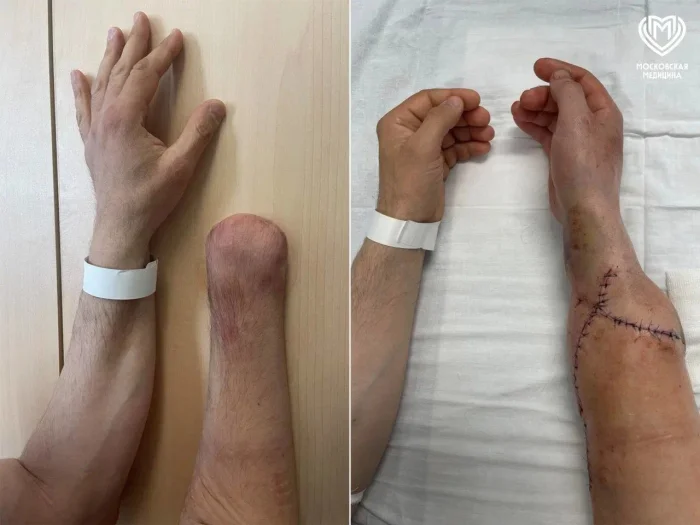 Россияне получили возможность бесплатной пересадки рук